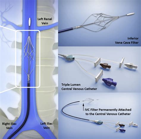The study addressed concerns that retrievable <b>IVC</b> <b>filters</b> can migrate or break apart after being implanted, leading to significant health risks for patients. . Cordis trapease ivc filter mri safety